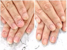 リファーレ(RIFARE)/【深爪矯正】トラブル爪も対応◎