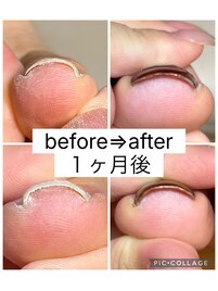 巻き爪ケア　１本3300円
