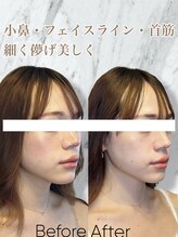 ルミライ(Lumirai)/ダウンタイムなしで別人級小顔