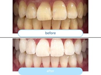 セルフメイド 東大阪店(SELFMADE)/医療提携ホワイトニング