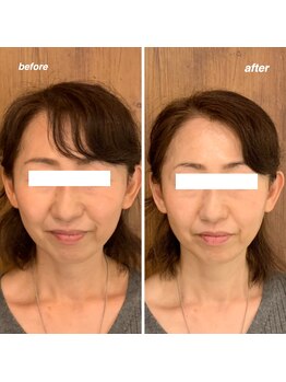 ドクターセリカ(Dr.SERIKA)の写真/ワンランク上のうるツヤ肌へ♪ 針のいらない水光肌ケアで叶えるご褒美美容＾＾