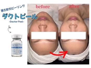 グラシア(gracia)の写真/ララピールを超えた！肌管理ピーリング♪毛穴・くすみ肌質改善を目指す方におすすめのダクトピール始動！