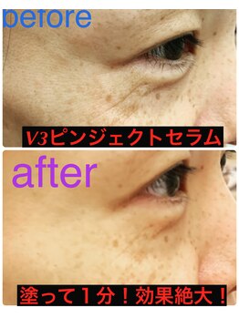 ビューティスペースグリッター(beauty space Glitter)/V3ピンジェクトセラム