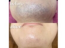 サロン ルーシュ(salon ruche)/脱毛(ひげ)