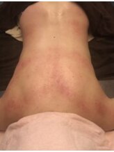 小顔 ツヤ肌/スライドカッピング効果