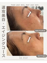 ラシュール(la sur)/シミ効果写真！