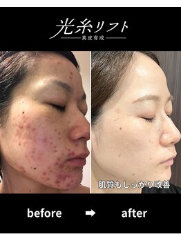 ヘルディン(heldin +555)/光糸リフト