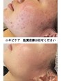 ヴィオール 名古屋栄店(VIOR)&nbsp;ニキビケア 徹底改善♪