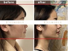 エルミオーレ(ELMIOLE)/◆20代【小顔MENU(国産)】4回