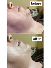 薫風/脂肪分解ケア／50代