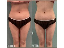 ベルゼル(Bellezell)/痩身1回