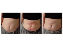 グランディールアン(GRANDIR UN)/脂肪冷却～10日の変化