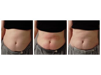 グランディールアン(GRANDIR UN)/脂肪冷却～10日の変化