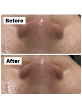 バイオ スキン プラス(Bio Skin Plus)/レモンボトルで毛穴ケア！