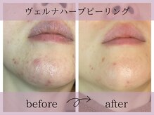 サロンドボーテアリス (Salon de beaute ALICE)/ヴェルナハーブピーリング