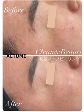 クリーンアンドビューティ 札幌(Clean&Beauty)/当日洗顔メイクもOKなニキビケア