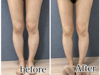 ビーホープ(B.hope)/30代モニター様1回目