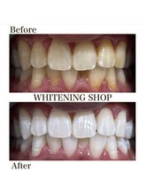 ホワイトニングショップ 池田店/【BEFORE/AFTER】