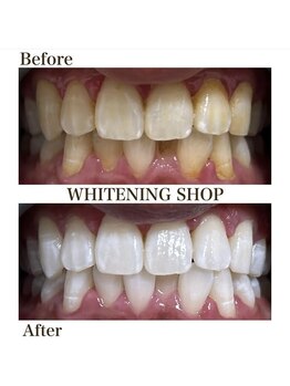 ホワイトニングショップ 池田店/【BEFORE/AFTER】