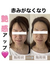 ブルーシー(BLUESEA)/【RHR】幹細胞ハーブピーリング