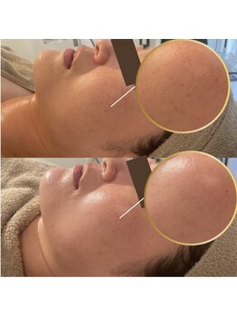 ホワイトアクア 中目黒店(WHITE AQUA)/ララピール/毛穴/中目黒