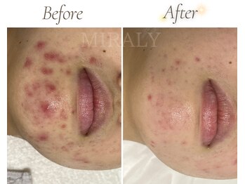ミラリー(MIRALY)/あごニキビケア6ヶ月(20代後半)