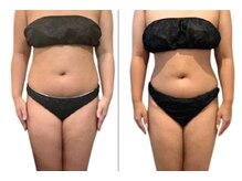 サロンドモフィ(salon de moffy)/痩身【脂肪冷却】おなか施術例３