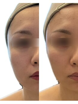 彌庵/インモード小顔ケア　症例