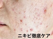 ココリラ(cocorira)/【ニキビ徹底ケア】