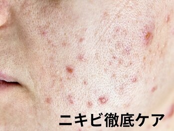 ココリラ(cocorira)/【ニキビ徹底ケア】