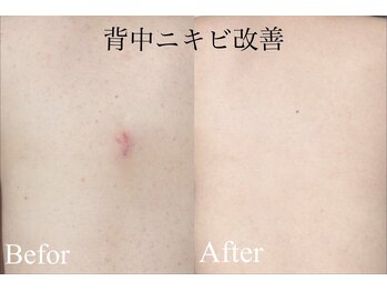 レア(le'a)/背中ニキビ改善！！