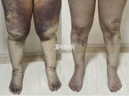 術後インディバ専門サロン 新宿の写真