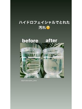 アモ(AMO)/ハイドロ毛穴洗浄