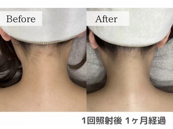 セオリー(Theory)/Before After