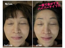 エムプラス フロム みずわき治療院(Mplus. from みずわき治療院)の雰囲気（１０分でこの仕上がり♪温かくて気持ちいいハイパーナイフ)^o^(）