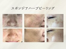 ホリスティックサロン ヘルバ(Holistic salon Herba)/スポンジアハーブピーリング