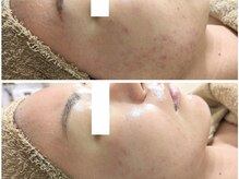 アン(anne)/ハーバルピール☆ レベル4×2回