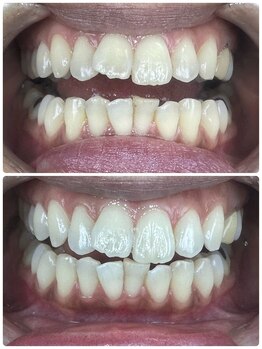 グラスプレイス/プレミアム症例 11