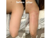 グレアージュ(GLEAGE)/全身痩身凹凸脂肪コース！