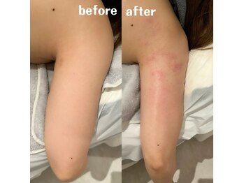 グレアージュ(GLEAGE)/全身痩身凹凸脂肪コース!