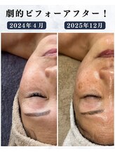 シーフェイス 横浜店(SEE FACE)/定期的な肌ケアでココまで変化！