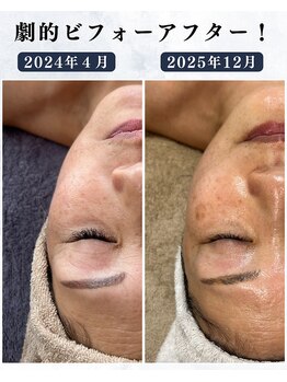 シーフェイス 横浜店(SEE FACE)/定期的な肌ケアでココまで変化!