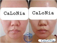 カロニア(CaLoNia)/たるみ・小顔ケア