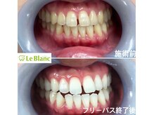 ルブラン 奈良店(Le Blanc)/夏までに美白歯に！！