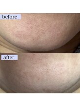 エアル(earu.)/BA|毛穴ケア|ピーリング|高円寺