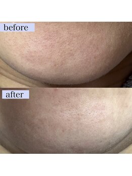 エアル(earu.)/BA|毛穴ケア|ピーリング|高円寺