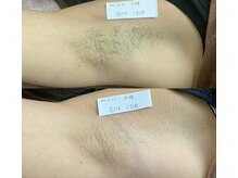 プリマ(Prima)/BEFORE&AFTER