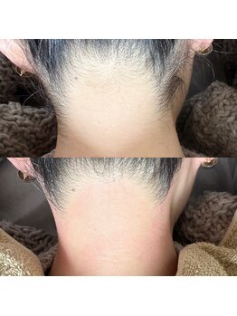 ルピナス(Lupinus)/うなじwax脱毛