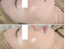 アン(anne)/ハーバルピール ☆ &nbsp;&nbsp;レベル7×3