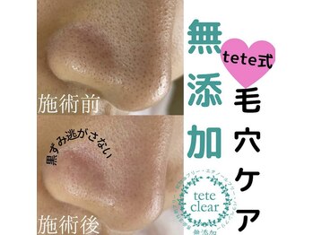 毛穴屋/毛穴洗浄毛穴エクストラクション